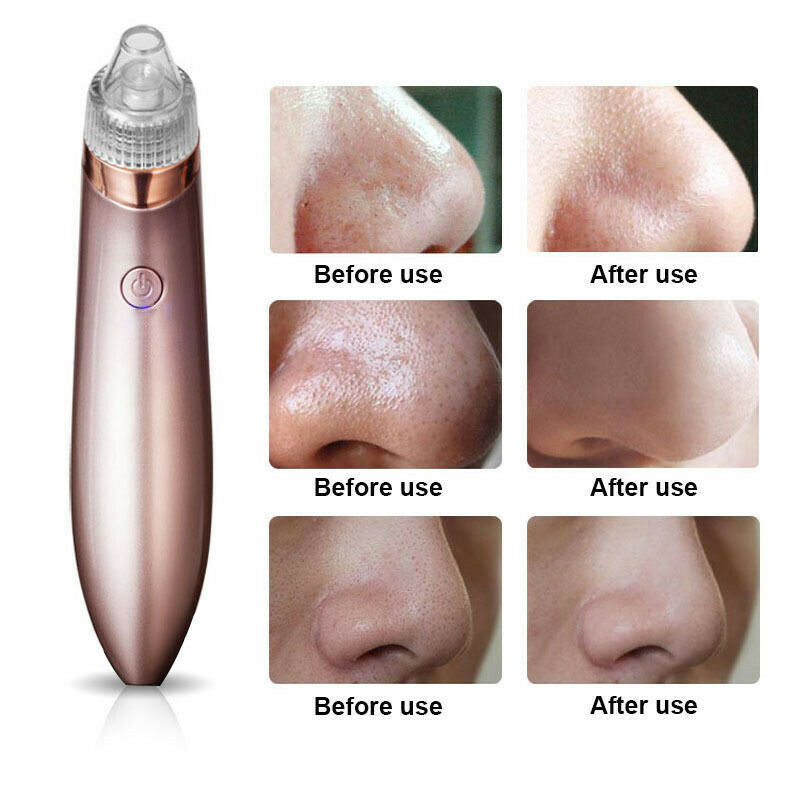 Electric Blackhead Vacuum Pore Cleaner - Acne Pimple Remover