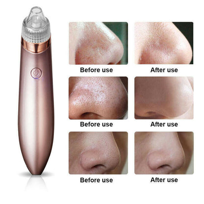 Electric Blackhead Vacuum Pore Cleaner - Acne Pimple Remover