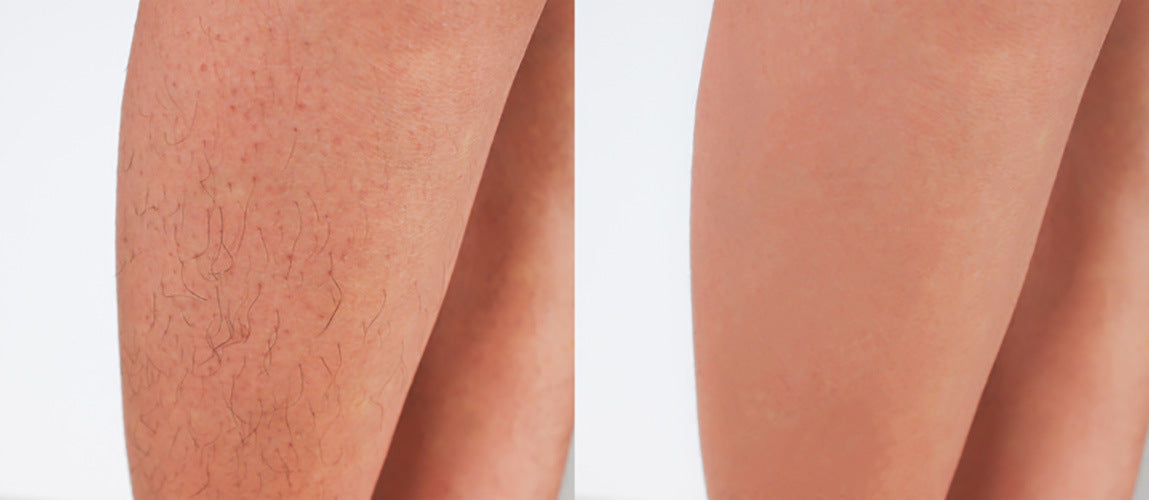 Hair Removal Device - Pain Free and Permanent Hair Removal