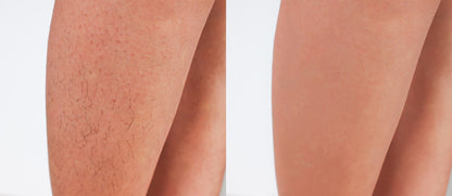 Hair Removal Device - Pain Free and Permanent Hair Removal