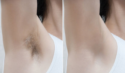 Hair Removal Device - Pain Free and Permanent Hair Removal