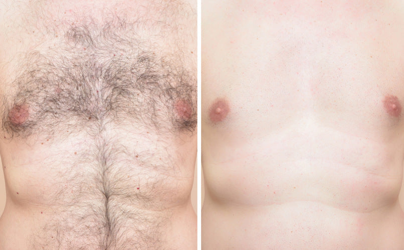 Hair Removal Device - Pain Free and Permanent Hair Removal